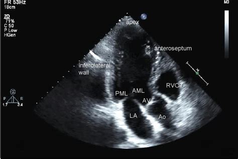 what is a tte echocardiogram